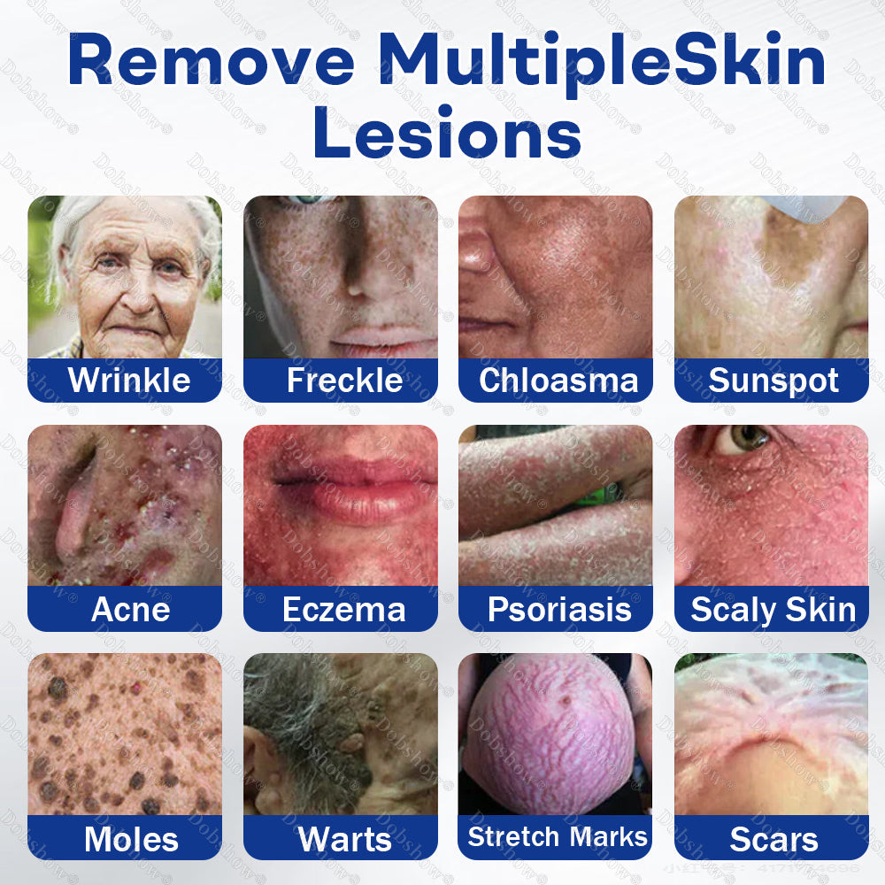 Healrize® 3-in-1 Microneedle & Hydrocolloid Skin Tag Patch