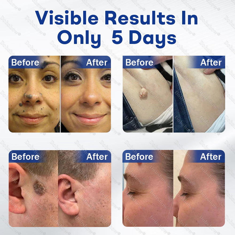 Healrize® 3-in-1 Microneedle & Hydrocolloid Skin Tag Patch