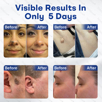 Healrize® 3-in-1 Microneedle & Hydrocolloid Skin Tag Patch
