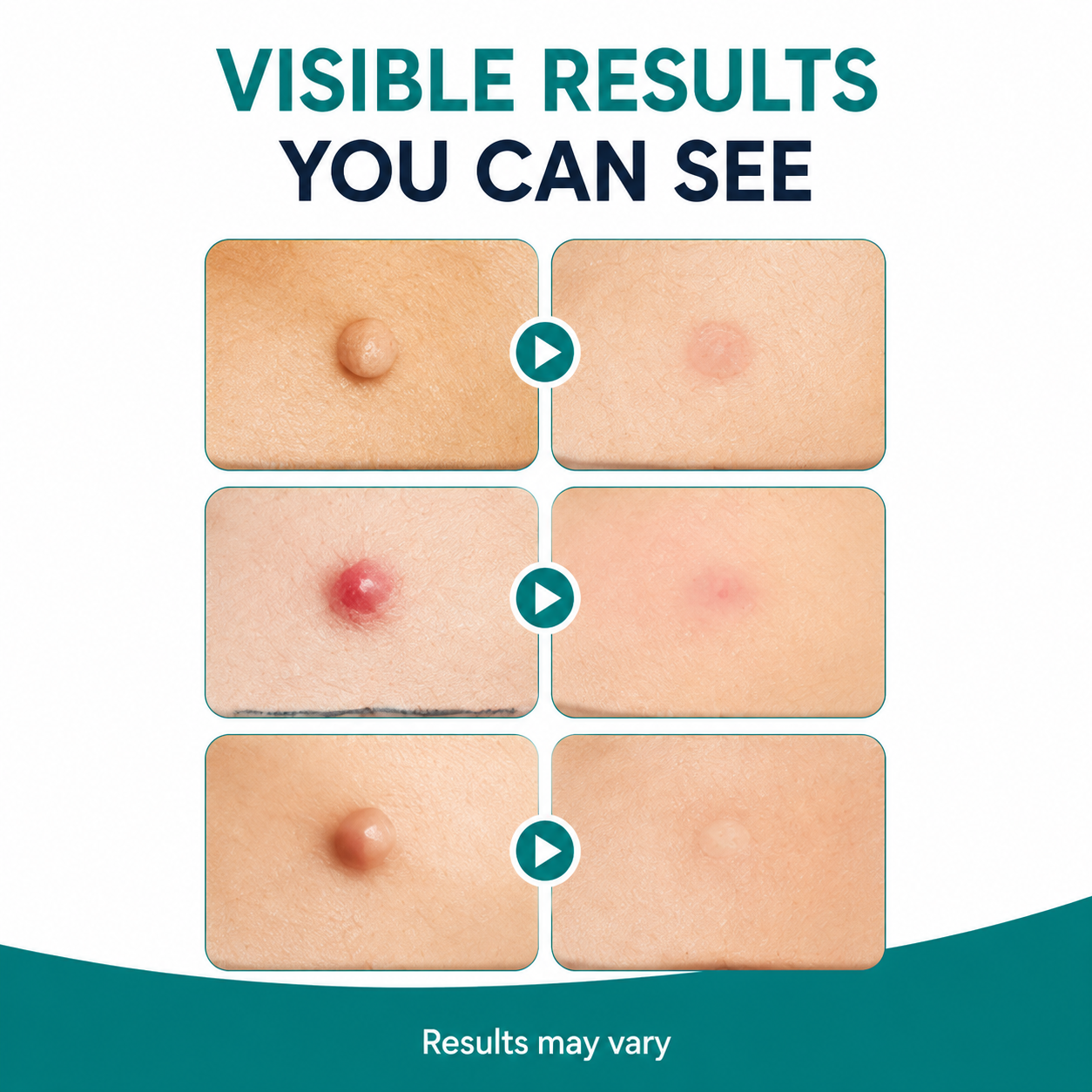 Dobshow® Blemish Clear Microneedle Patches – Invisible Skin Care Solution for Targeted Spot Treatment
