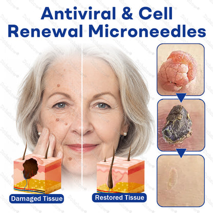 Healrize® 3-in-1 Microneedle & Hydrocolloid Skin Tag Patch