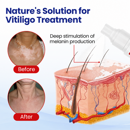 Dobshow® Pigment Balance Spray– Targeted Vitiligo & White Patch Care | Supports Melanin Production, Pigment Balance & Natural-Looking Skin Tone