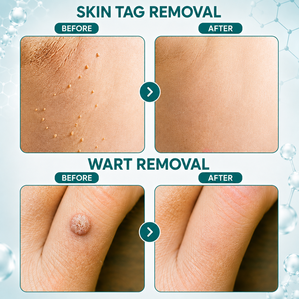 ✨Dobshow® Blemish Clear Microneedle Patches🩹🩹